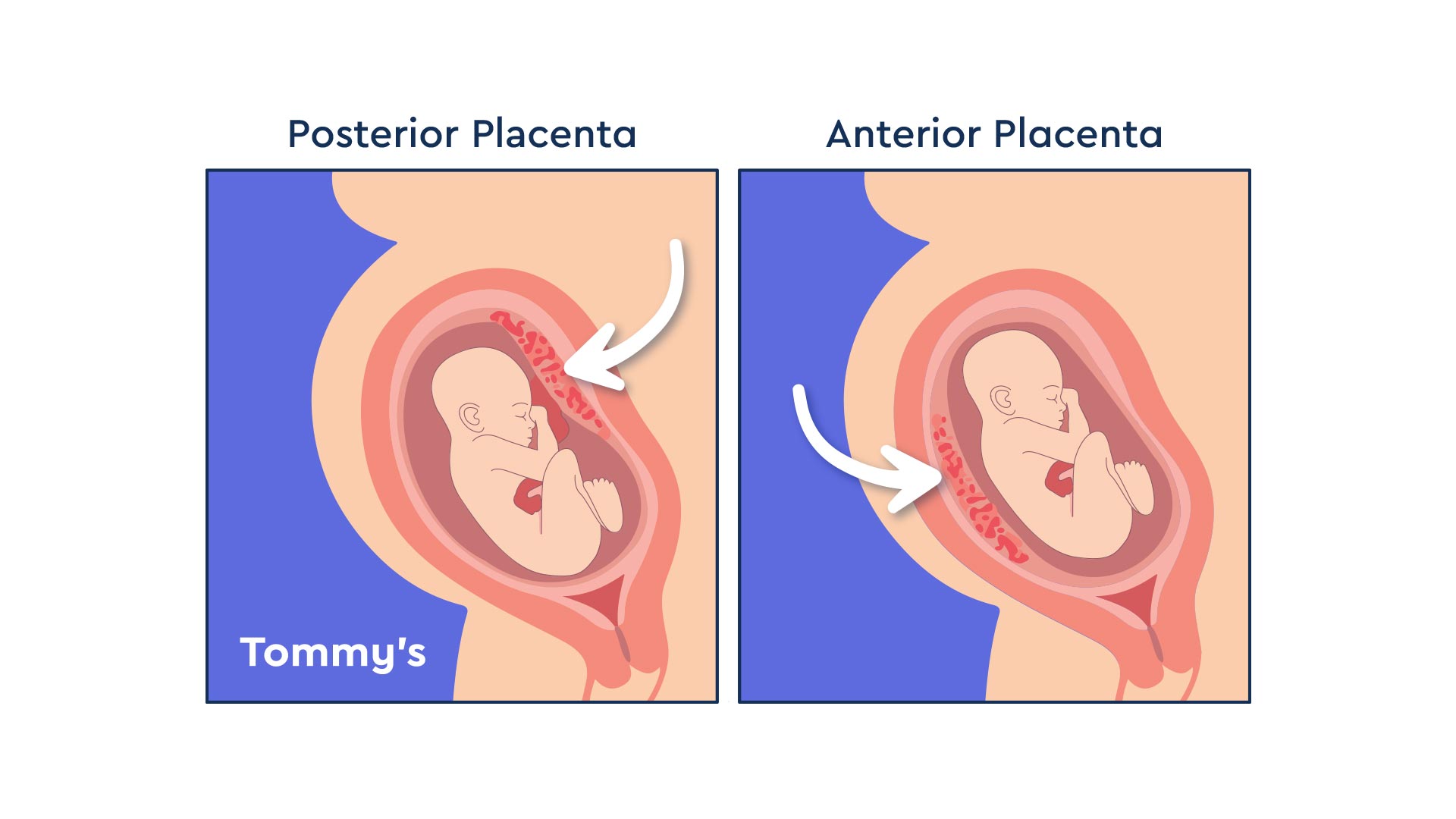 Placenta Comparison 1920x1080b 0 