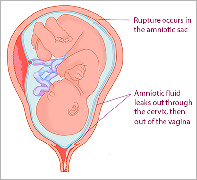 WHAT TO DO IF YOUR WATER BREAKS  Am I leaking Amniotic Fluid or