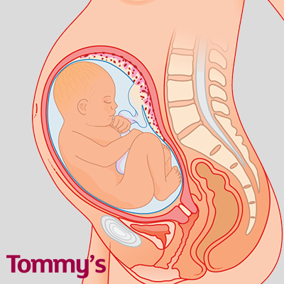 Ultrasound At 36 Weeks Could Avoid Birth Complications Tommy S